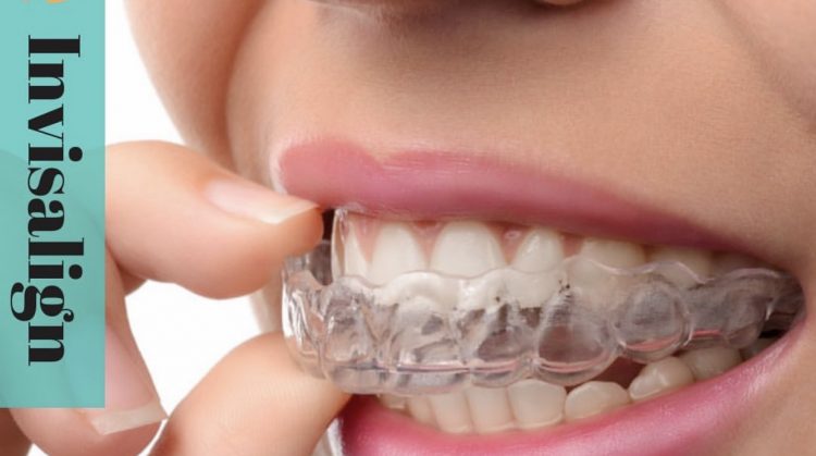 Alinhadores Invisíveis: Dentes tortos nunca mais! - Stelle Odontologia